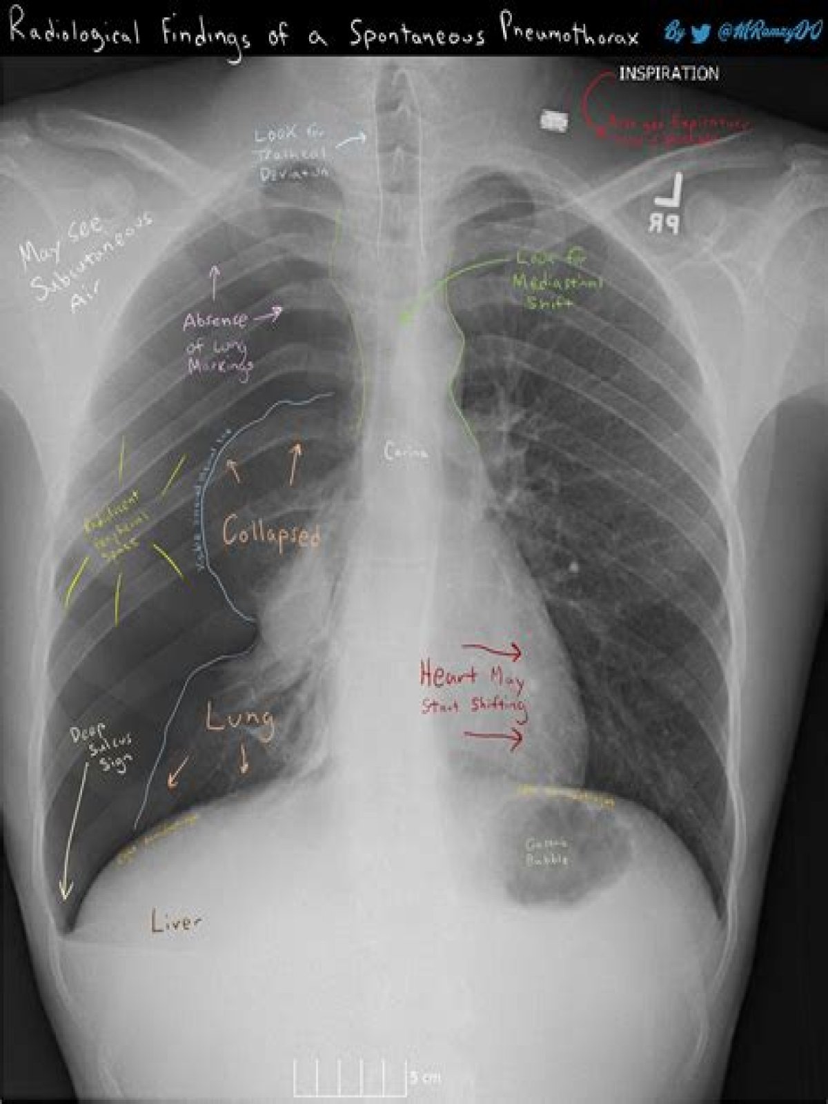 How does a pneumothorax look on an X ray?