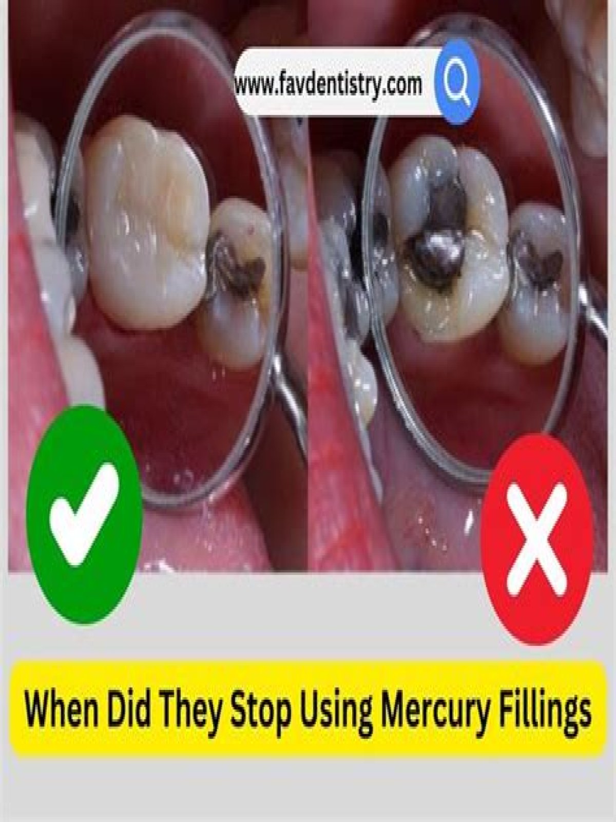 When did dentist stop using mercury fillings?